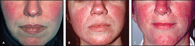 acne rosacea 