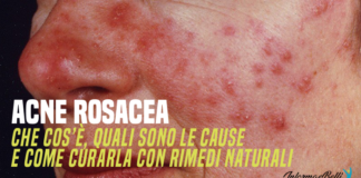 acne rosacea