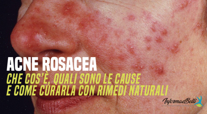 Acne rosacea: che cos’è, quali sono le cause e come curarla con rimedi naturali acne rosacea