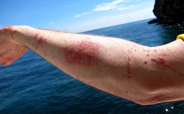 puntura di medusa rimedi naturali