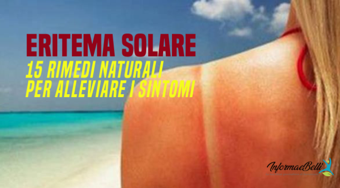 Eritema solare rimedi naturali