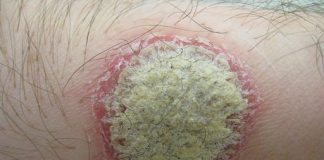 psoriasi, le forme, le cause, la cura