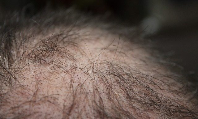 Caduta capelli: quando è fisiologica, quando preoccuparsi caduta capelli