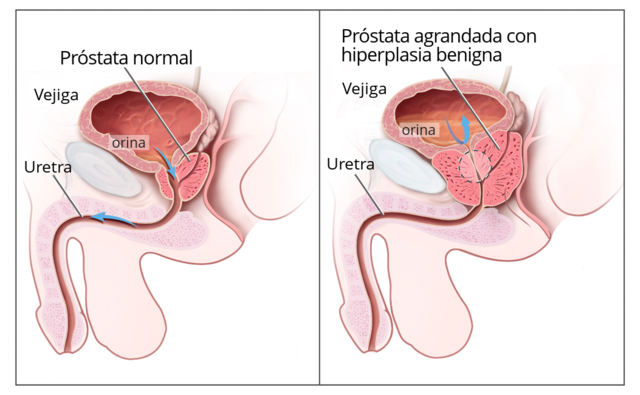Prosztata adenoma volumen 53, Prostata adenoma centrale