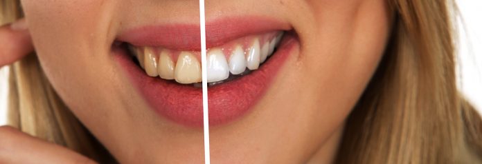 Rendere i denti più bianchi