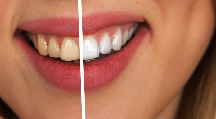 Ottenere denti più bianchi con i rimedi naturali: i prodotti più efficaci Rendere i denti più bianchi