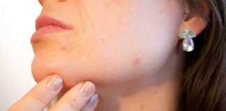 Rimedi naturali contro l'acne