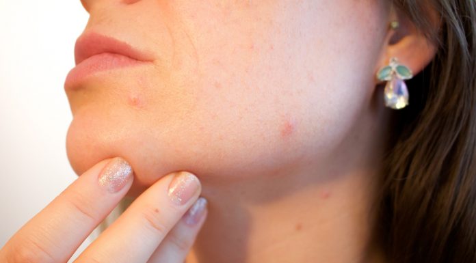 Rimedi naturali contro l'acne