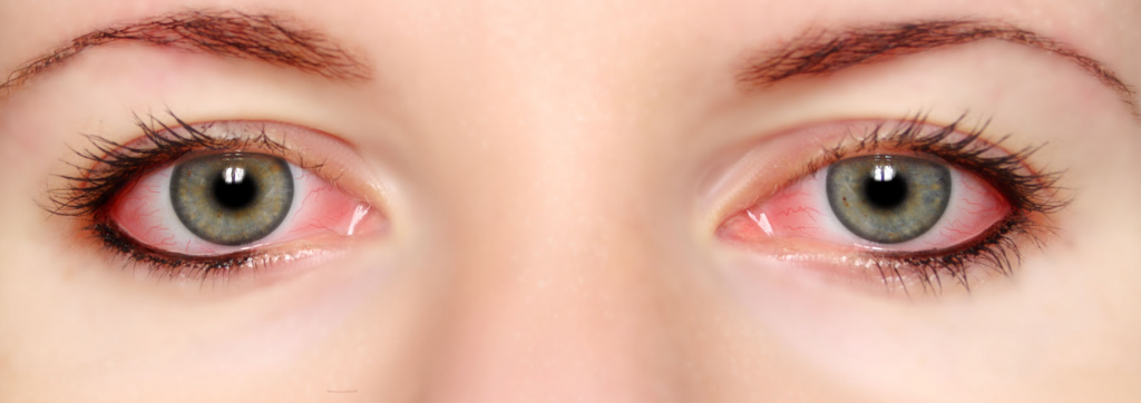 Cause degli occhi secchi